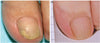 Tratamiento Anti Hongos 100% Natural 7 Días