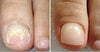 Tratamiento Anti Hongos 100% Natural 7 Días